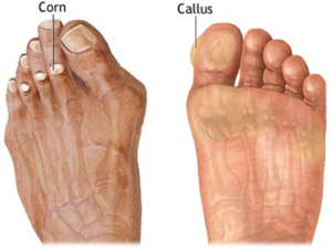 How to Remove Calluses