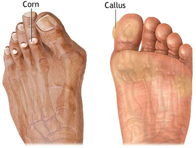 Can I Remove Minor Calluses From My Feet?