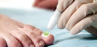 fungal-nail-laser-therapy