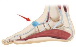 ganglion-cysts